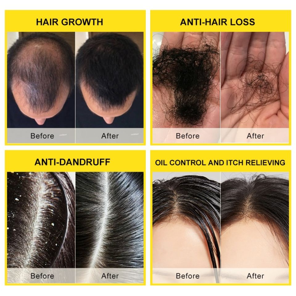 Rosemary & Ginger Oil Anti-Dandruff Hair Growth Cream S8d5399f682664b44b000818508d98aaby 60020503
