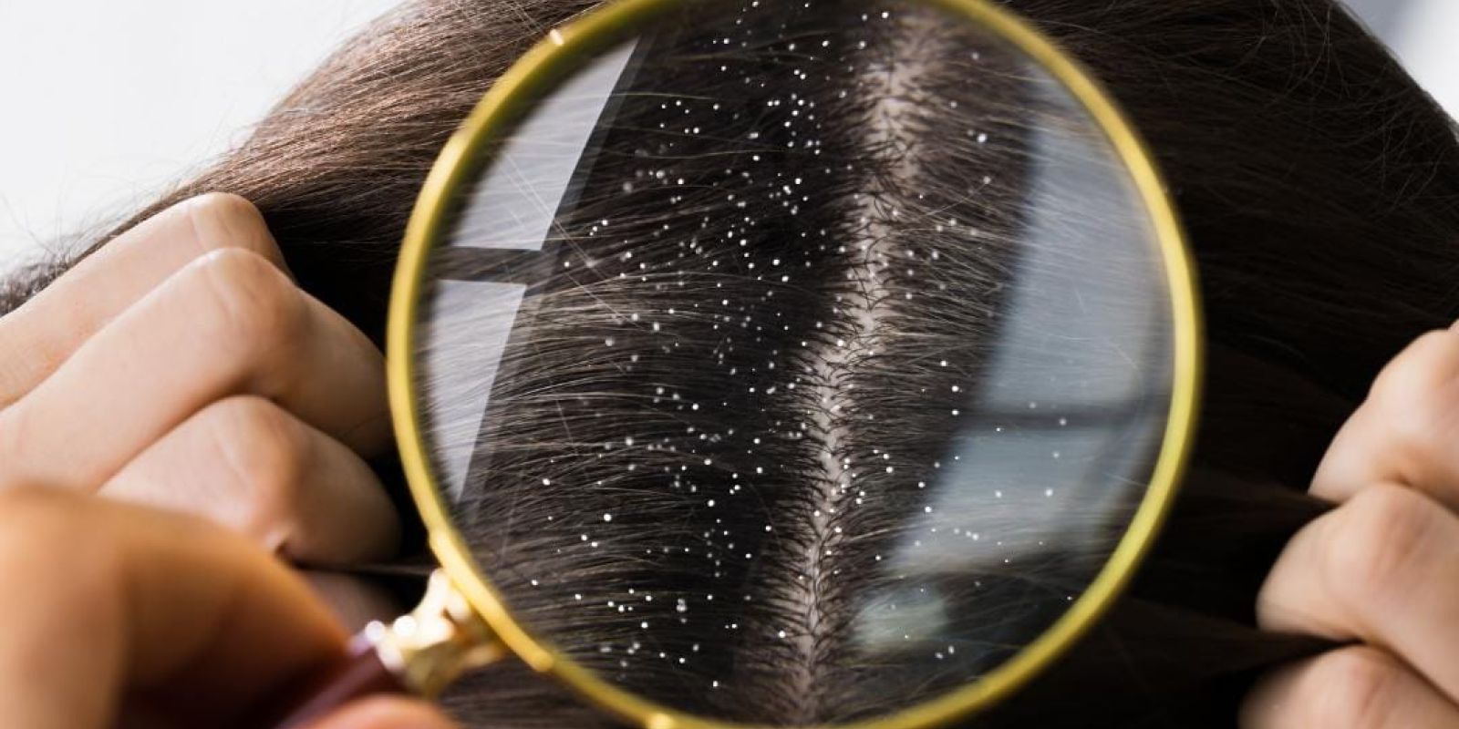 <strong>Dandruff: Types, Causes, Treatments & More!</strong> WhatsApp Image 2023 04 21 at 09.54.37 7123c358