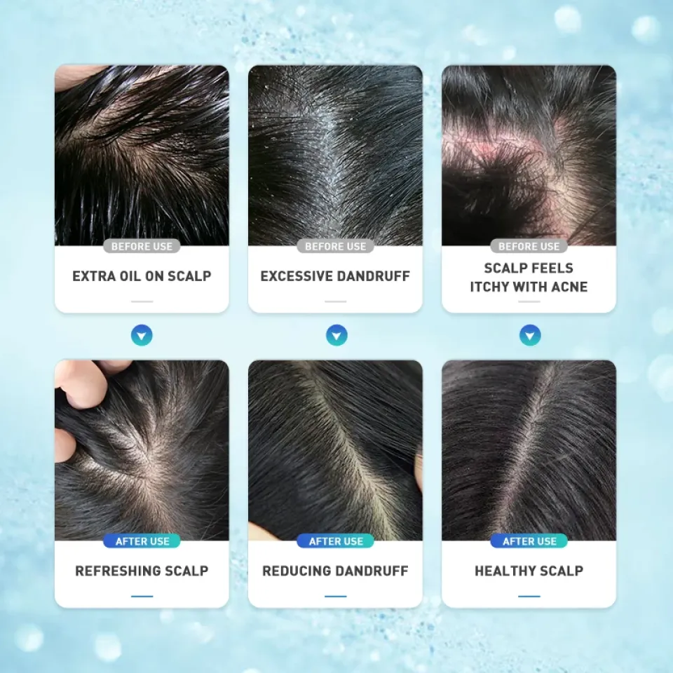 Anti-Dandruff Scalp Treatment Gel H1297209902aa47b7ad65833691c18658W 91ffba5b