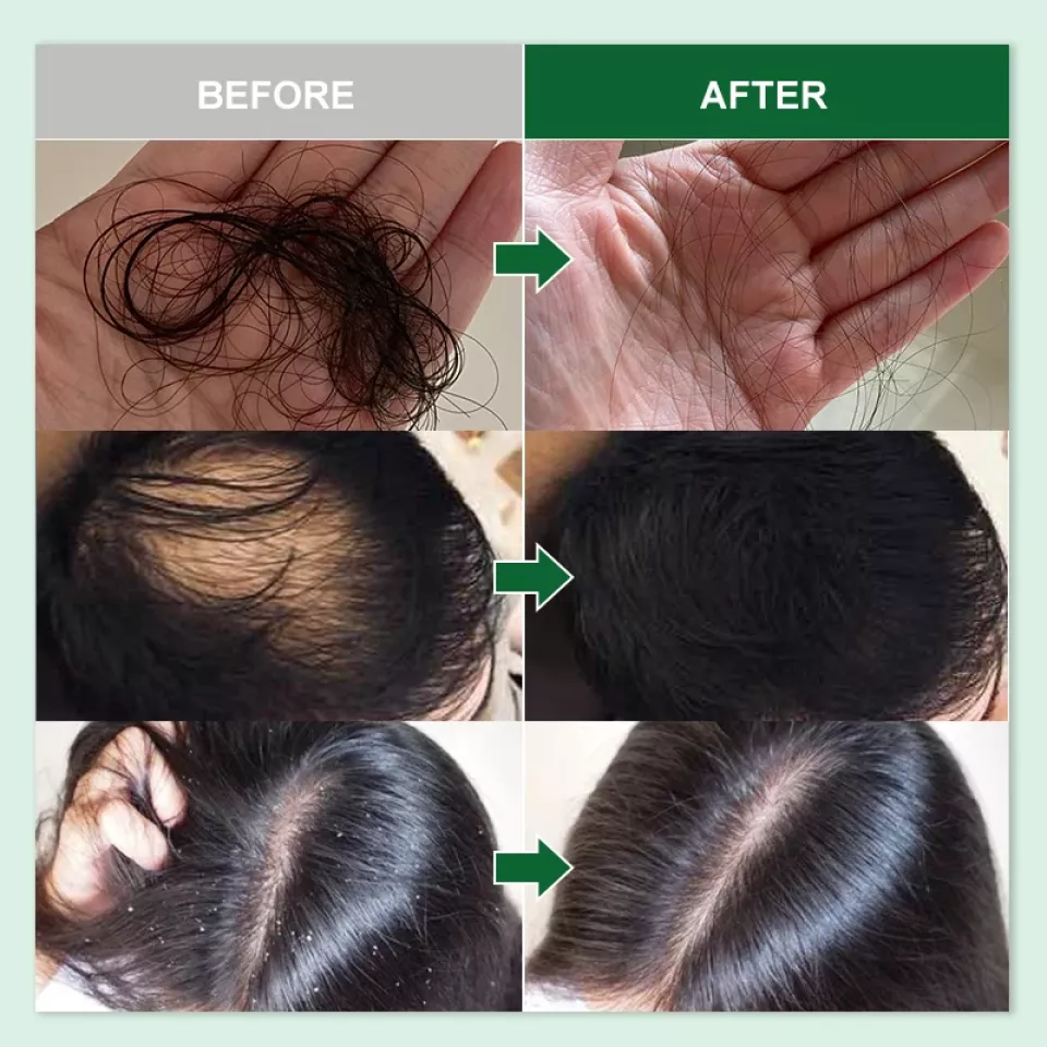 Natural Rosemary Hair Growth Essential Oil S8a99858a388a4929930dd8fe7ffc9938C a4f1e518