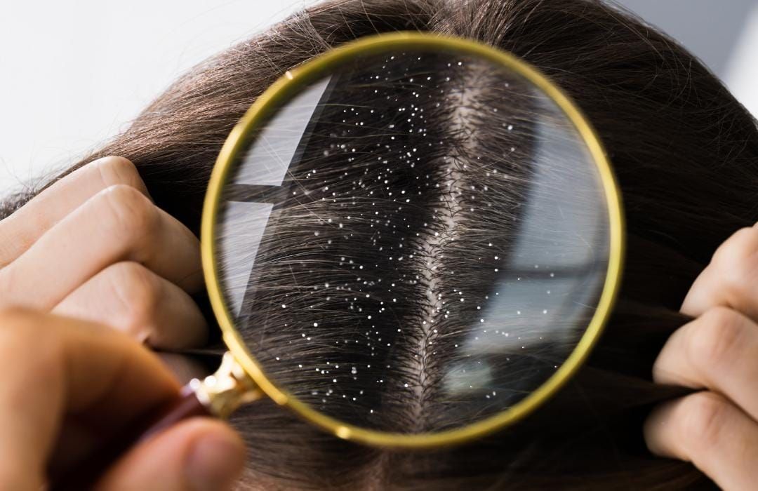 dandruff