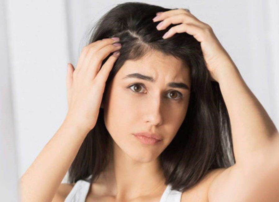 Benefits Of Adding Hair Mask To Your Hair Care Regime dandruff thumb1613455282 d7e054d6
