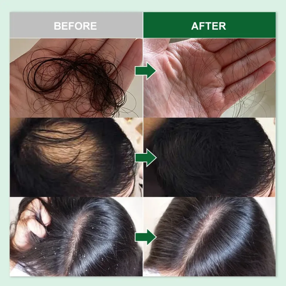 PURC Natural Rosemary Hair Growth Essential Oil S8a99858a388a4929930dd8fe7ffc9938C ef07814d