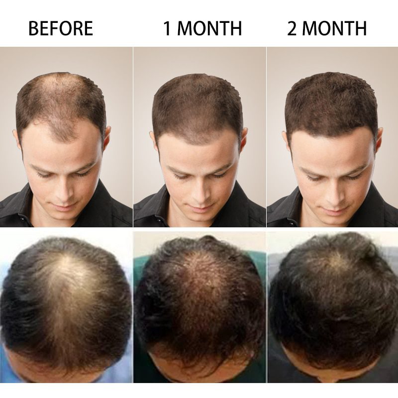 Hair Growth Spray PURC Hot sale Fast Hair Growth Essence Oil Hair Loss Treatment Help for hair Growth Hair 2