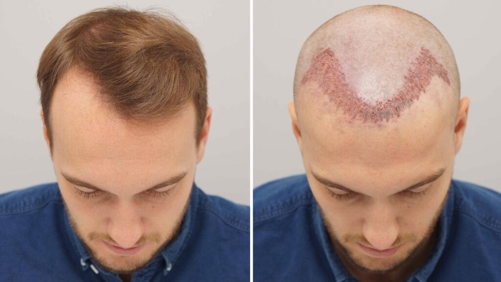 How To Stop A Receding Hairline & Regrow Hair hair transplant