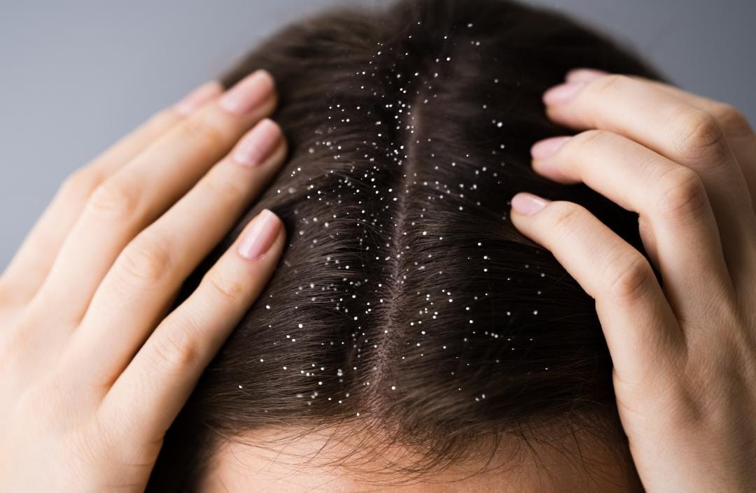 Dandruff Types Causes Treatments And More Easy Guide