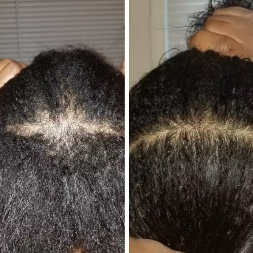 PURC Ginger Herbal Scalp Care Hair Shampoo biotin hair growth shampoo and anti hair loss spray combo testimonials 3