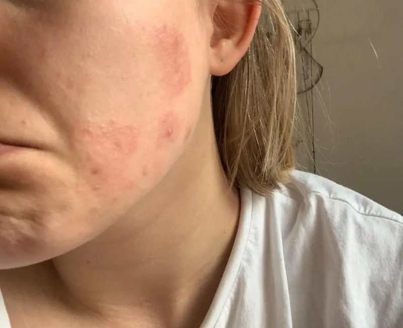 Damaged-skin-barrier Damaged-skin-barrier