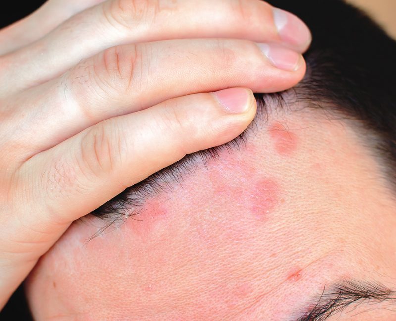 5 Signs Of Scalp Inflammation & How To Heal It - PURC Organics