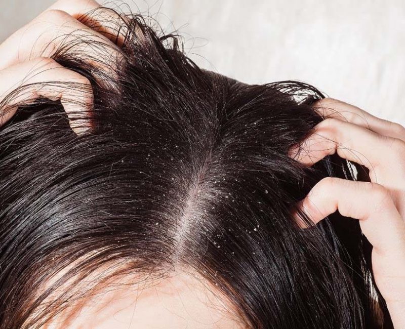 5 Signs Of Scalp Inflammation & How To Heal It - PURC Organics